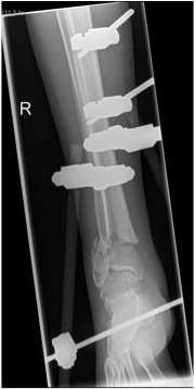 Distal Tibial Fracture External Fixation